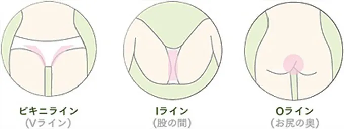 VIOの脱毛範囲