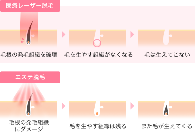 医療脱毛とエステ脱毛の毛が抜ける仕組み
