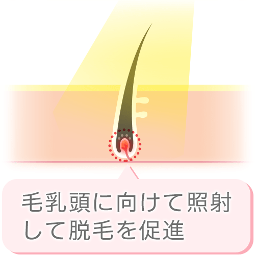 IPL脱毛