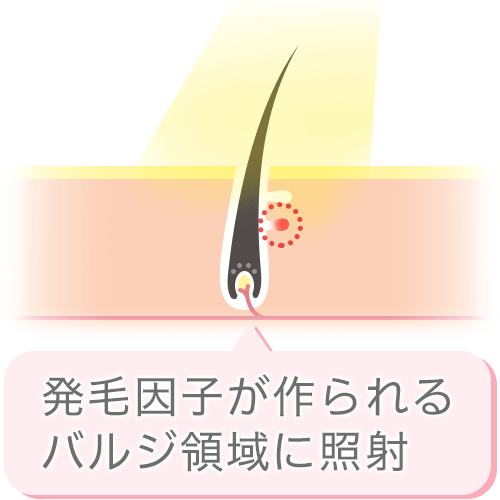 SHR脱毛